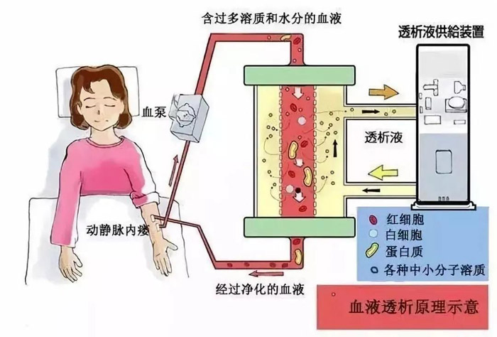 关于肾病患者三种透析方式,究竟哪一种最合适?