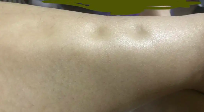 关于尿蛋白的一些疑问?肾病患者怎样去控制?