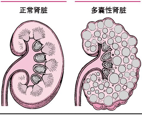 什么是多囊肾?都有哪些症状?