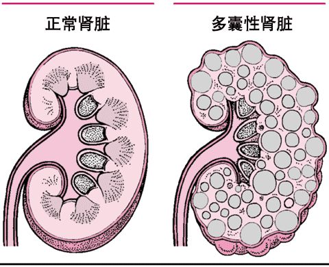 什么是多囊肾？都有哪些症状？