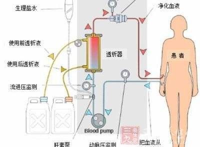 关于尿毒症透析及换肾的一些侃谈！如何避免？