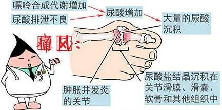 痛风会不会遗传给后代?平时需要注意什么?