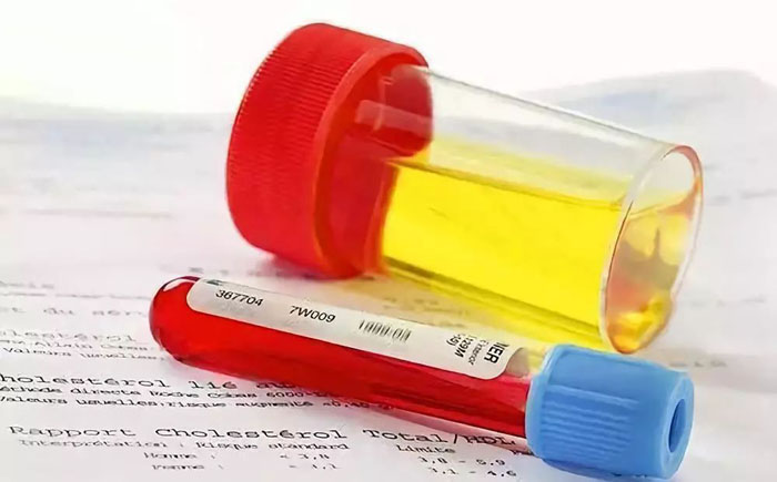 治疗肾病常见的两种方案 肯定有一种您正在尝试!