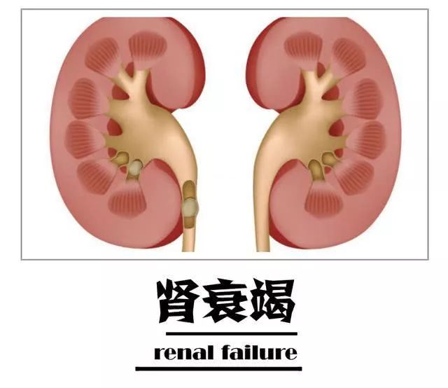 肾病健康知识:避免肾衰发展成尿毒症?这几点很重要!