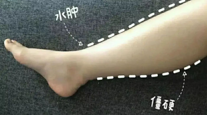关于肾病水肿的确诊与分型,以及怎样对症用药?