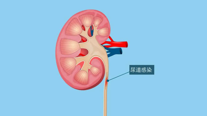 肾病健康知识分享:关于肾盂肾炎该怎样预防以及治疗?