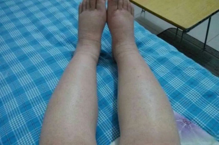 不同之处!关于肾病综合症的中医分型与治疗
