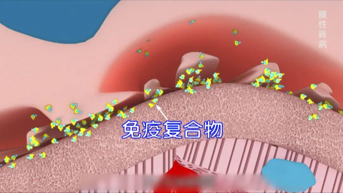 肾病的起因是什么？为什么会得肾病？该怎样进行彻底治疗？