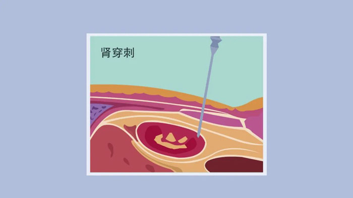 肾病的诊断和治疗方案需要依靠肾脏穿刺吗?